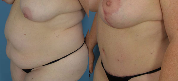 Female body, before and after Tummy Tuck treatment, l-side oblique view, patient 19