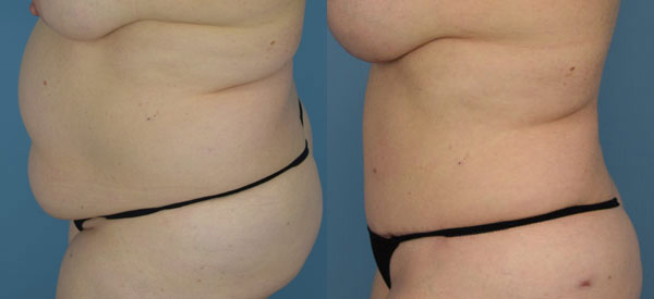 Female body, before and after Tummy Tuck treatment, l-side view, patient 19