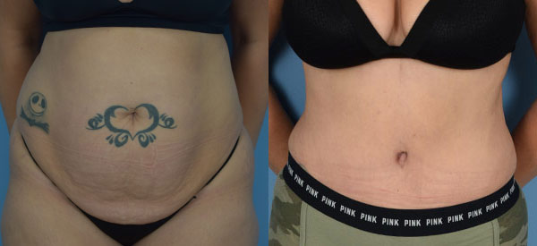 Female body, before and after Tummy Tuck treatment, front view, patient 20