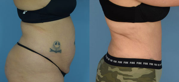 Female body, before and after Tummy Tuck treatment, r-side view, patient 20