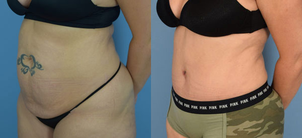 Female body, before and after Tummy Tuck treatment, l-side oblique view, patient 20