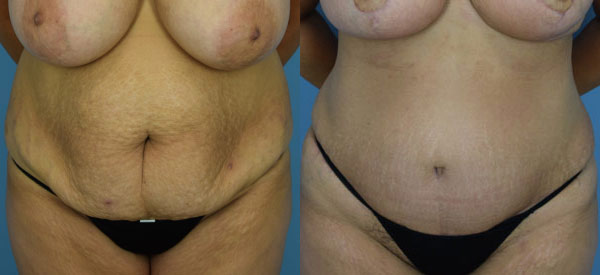 Female body, before and after Tummy Tuck treatment, front view, patient 21