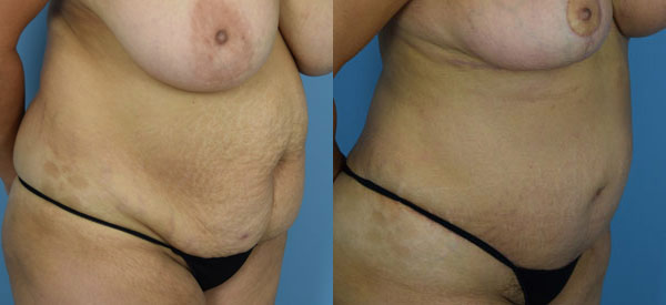 Female body, before and after Tummy Tuck treatment, r-side oblique view, patient 21