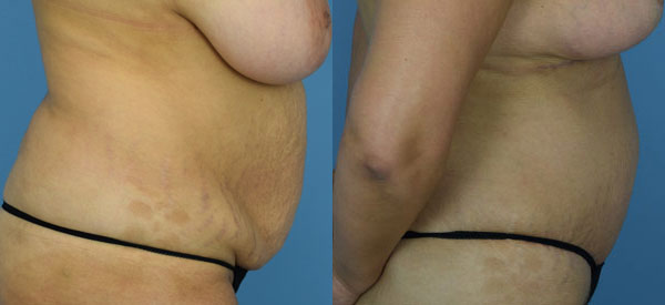 Female body, before and after Tummy Tuck treatment, r-side view, patient 21