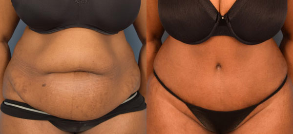 Female body, before and after Tummy Tuck treatment, front view, patient 22
