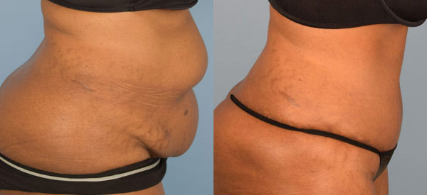 Female body, before and after Tummy Tuck treatment, r-side view, patient 22