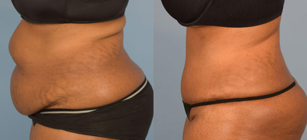 Female body, before and after Tummy Tuck treatment, l-side view, patient 22