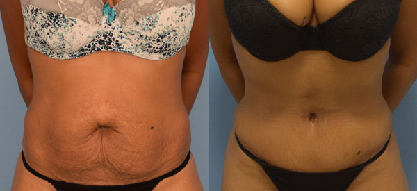 Female body, before and after Tummy Tuck treatment, front view, patient 24
