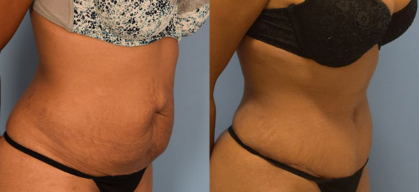 Female body, before and after Tummy Tuck treatment, r-side view, patient 24