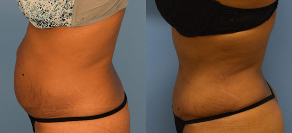 Female body, before and after Tummy Tuck treatment, l-side view, patient 24
