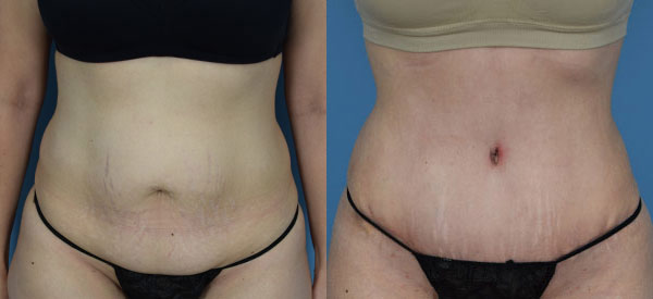 Female body, before and after Tummy Tuck treatment, front view, patient 6