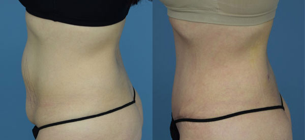 Female body, before and after Tummy Tuck treatment, l-side view, patient 6