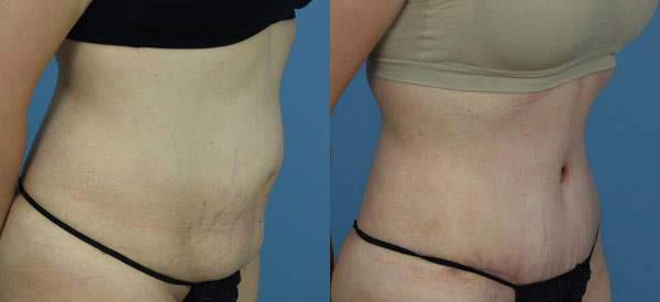 Female body, before and after Tummy Tuck treatment, r-side oblique view, patient 6
