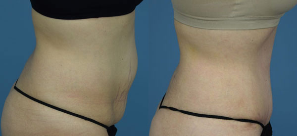 Female body, before and after Tummy Tuck treatment, r-side view, patient 6