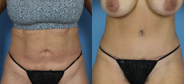Female body, before and after Tummy Tuck treatment, front view, patient 25