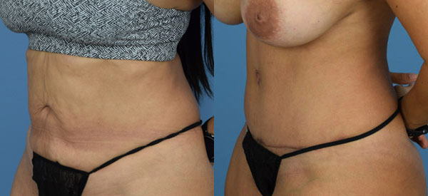 Female body, before and after Tummy Tuck treatment, l-side oblique view, patient 25