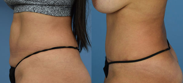 Female body, before and after Tummy Tuck treatment, l-side view, patient 25
