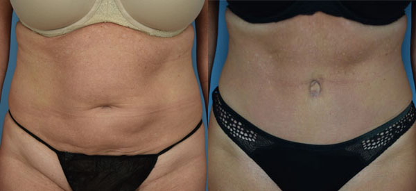 Female body, before and after Tummy Tuck treatment, front view, patient 26