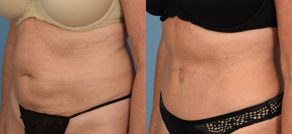 Female body, before and after Tummy Tuck treatment, l-side oblique view, patient 26
