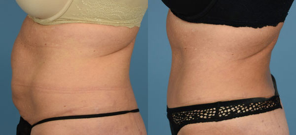 Female body, before and after Tummy Tuck treatment, l-side view, patient 26