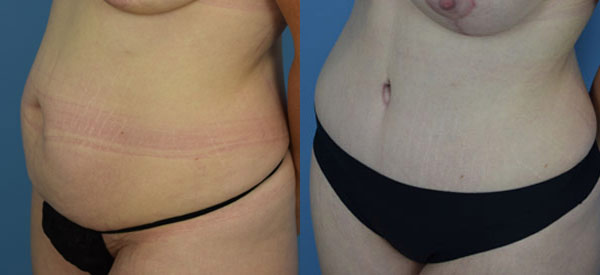 Female body, before and after Tummy Tuck treatment, l-side oblique view, patient 27