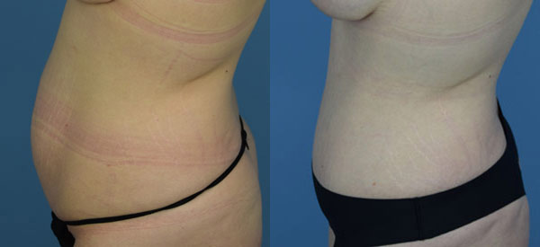 Female body, before and after Tummy Tuck treatment, l-side view, patient 27