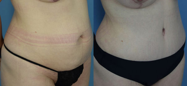 Female body, before and after Tummy Tuck treatment, r-side oblique view, patient 27