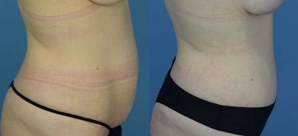 Female body, before and after Tummy Tuck treatment, r-side view, patient 27