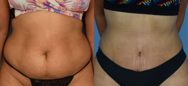 Female body, before and after Tummy Tuck treatment, front view, patient 28