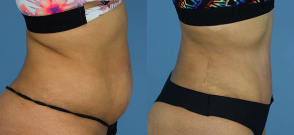 Female body, before and after Tummy Tuck treatment, l-side view, patient 28