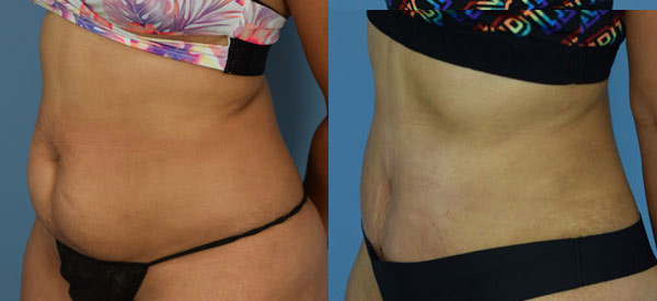 Female body, before and after Tummy Tuck treatment, l-side oblique view, patient 28