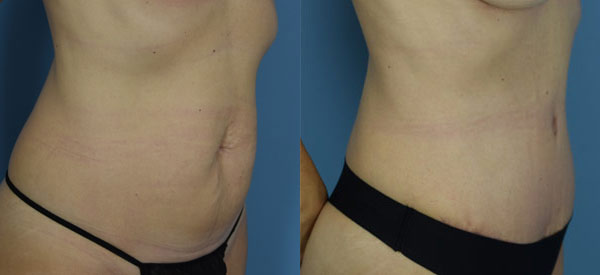 Female body, before and after Tummy Tuck treatment, r-side oblique view, patient 30