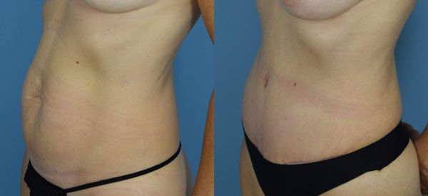 Female body, before and after Tummy Tuck treatment, l-side view, patient 30