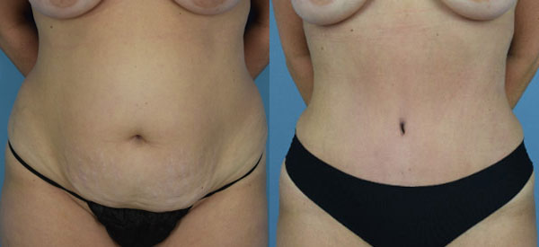 Female body, before and after Tummy Tuck treatment, front view, patient 31