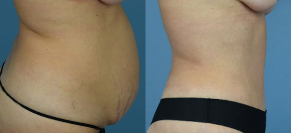 Female body, before and after Tummy Tuck treatment, r-side view, patient 31