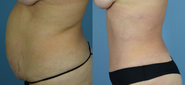 Female body, before and after Tummy Tuck treatment, l-side view, patient 31