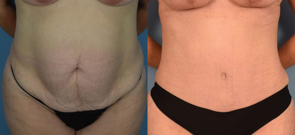 Female body, before and after Tummy Tuck treatment, front view, patient 32