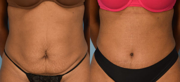 Female body, before and after Tummy Tuck treatment, front view, patient 34