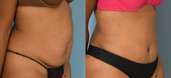 Female body, before and after Tummy Tuck treatment, r-side oblique view, patient 34