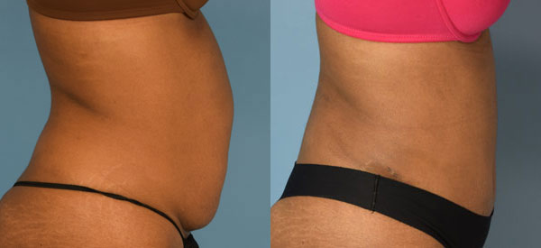 Female body, before and after Tummy Tuck treatment, r-side view, patient 34