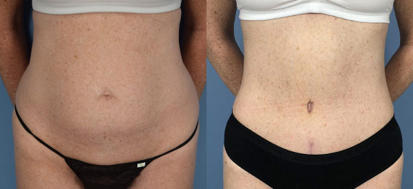 Female body, before and after Tummy Tuck treatment, front view, patient 35