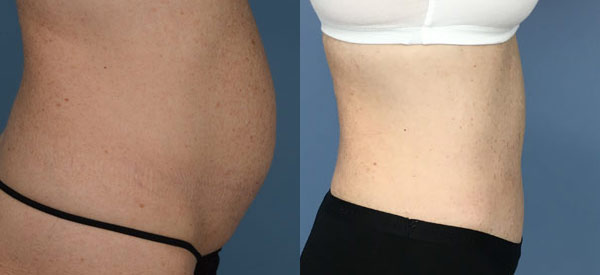Female body, before and after Tummy Tuck treatment, r-side view, patient 35