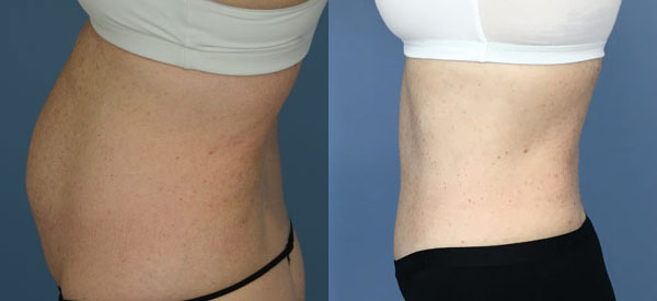 Female body, before and after Tummy Tuck treatment, l-side oblique view, patient 35