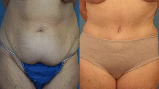 Female body, before and after Tummy Tuck treatment, front view, patient 11
