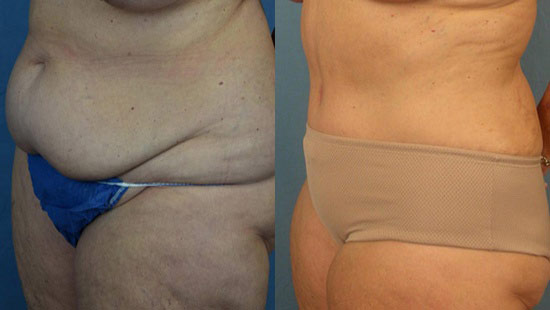 Female body, before and after Tummy Tuck treatment, l-side oblique view, patient 11