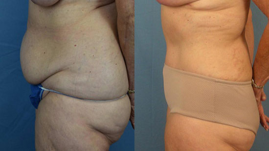 Female body, before and after Tummy Tuck treatment, l-side view, patient 11