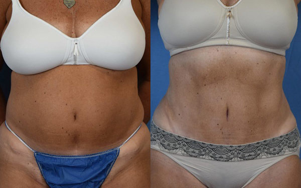 Female body, before and after Tummy Tuck treatment, front view, patient 1
