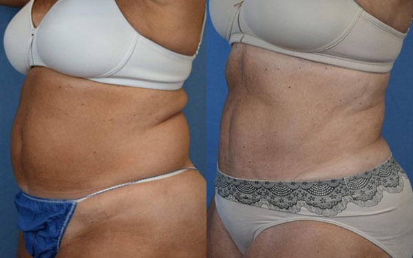 Female body, before and after Tummy Tuck treatment, l-side oblique view, patient 1