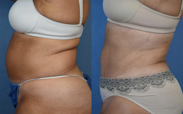 Female body, before and after Tummy Tuck treatment, l-side view, patient 1