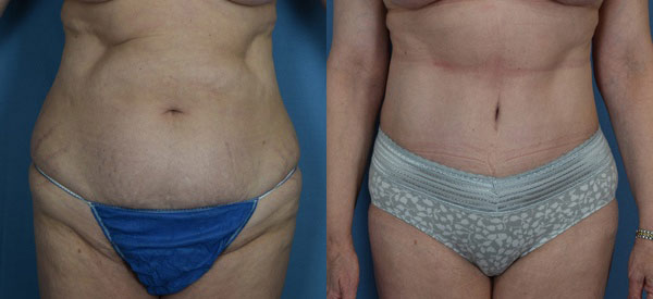 Female body, before and after Tummy Tuck treatment, front view, patient 12